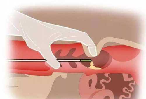 深圳52岁高龄女性三代试管婴儿成功率与费用解析及二代流程指南